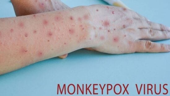 मंकीपॉक्स (Mpox) म्हणजे काय?