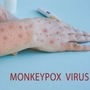 मंकीपॉक्स (Mpox) म्हणजे काय? मंकीपॉक्स (Mpox) म्हणजे काय?