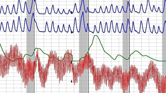 त्यामुळे त्याच्या सत्यतेबाबत साशंकता आहे. आतापर्यंत याचा वापर तपासासाठी करण्यात आला आहे. या चाचणीचे निकाल अचूक मानले जात नाहीत.