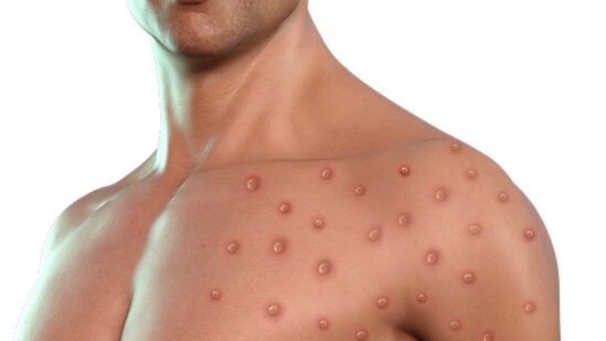 Mpox: एमपॉक्समुळे लॉकडाऊन लागणार का