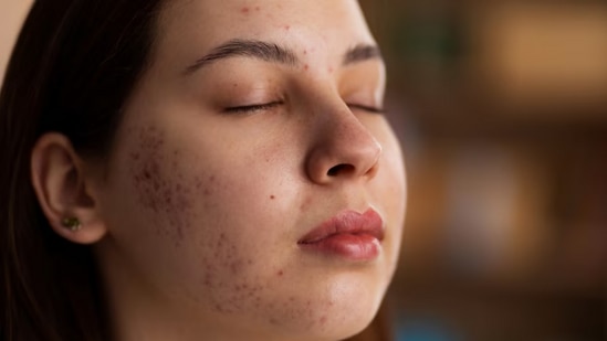 Remedies to remove dark spots on face