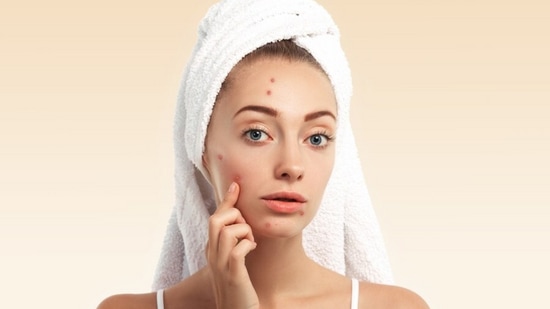 Pimples Home Remedies