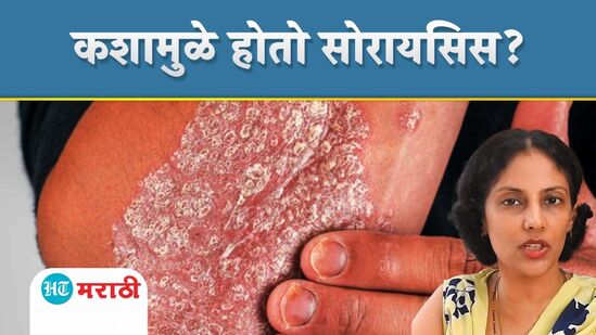 सोरायसिस सोरायसिस