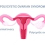 pcos symptoms and treatment pcos symptoms and treatment