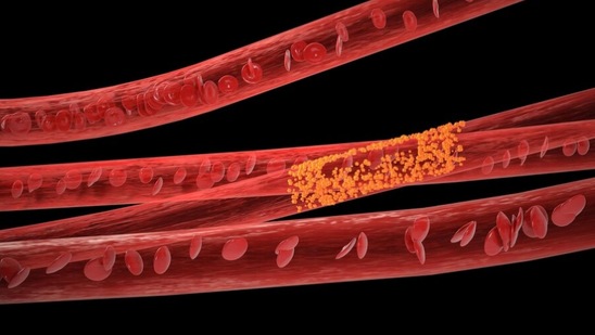 शरीरातील यूरिक ऍसिडची पातळी नियंत्रित करण्यासाठी, आपण आपल्या आहाराकडे विशेष लक्ष दिले पाहिजे. याशिवाय काही घरगुती उपायांनीही यूरिक ॲसिडवर नियंत्रण ठेवता येते. या घरगुती उपायांमध्ये लसणाचाही समावेश आहे. &nbsp;लसणाच्या सेवनाने यूरिक ऍसिड नियंत्रित ठेवण्यास मदत होते. चला तर मग जाणून घेऊया जास्त यूरिक ॲसिडच्या समस्येत लसूण किती फायदेशीर आहे आणि त्याचे सेवन कसे करावे?