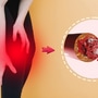 How To Reduce Uric Acid In Marathi How To Reduce Uric Acid In Marathi