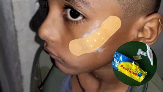 लहान मुलाच्या जखमेवर टाके घालण्याऐवजी फेविक्विक लावलं