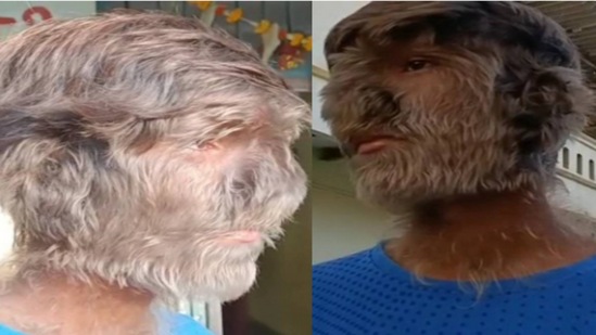 या आजारामुळे चेहऱ्यावर आणि शरीरावर लांब आणि दाट केस येतात