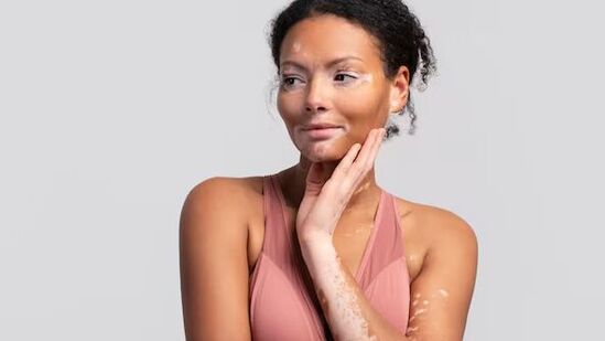 World Vitiligo Day