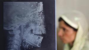 An X-ray sheet shows pellet injuries on Insha Malik as a relative sits by her hospital bed in Srinagar.(AP File Photo) An X-ray sheet shows pellet injuries on Insha Malik as a relative sits by her hospital bed in Srinagar.(AP File Photo)