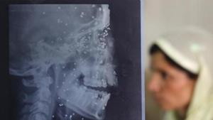 An X-ray sheet shows pellet injuries on Insha Malik, 14, as a relative sits by her hospital bed in Srinagar, Indian controlled Kashmir, Wednesday, July 20, 2016. Insha was hit by pellets while watching a protest.(AP Photo) An X-ray sheet shows pellet injuries on Insha Malik, 14, as a relative sits by her hospital bed in Srinagar, Indian controlled Kashmir, Wednesday, July 20, 2016. Insha was hit by pellets while watching a protest.(AP Photo)