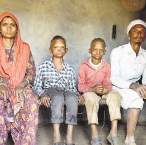 The Khan children, Ashfaq and Mushtaq, who are suffering from HED, have been ridiculed, pelted with stones and have even had dogs set on them because they look different, in their village in Rampur.(Mujeeb Faruqui/HT PHOTO) The Khan children, Ashfaq and Mushtaq, who are suffering from HED, have been ridiculed, pelted with stones and have even had dogs set on them because they look different, in their village in Rampur.(Mujeeb Faruqui/HT PHOTO)