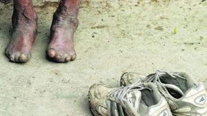Leprosy, also known as Hansen’s disease, is a chronic infectious, but curable bacterial disease, that mainly affects the skin and the eyes. Leprosy is known to occur at all ages ranging from early infancy to very old age.(HT File) Leprosy, also known as Hansen’s disease, is a chronic infectious, but curable bacterial disease, that mainly affects the skin and the eyes. Leprosy is known to occur at all ages ranging from early infancy to very old age.(HT File)