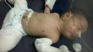 The baby, born to a 19-year-old woman, had a 7 cms foetus growing inside him.(Photo credit: Neena Nichlani) The baby, born to a 19-year-old woman, had a 7 cms foetus growing inside him.(Photo credit: Neena Nichlani)