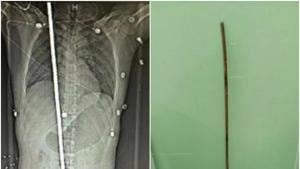 The hospital has released his X-ray report on the Weibo, Chinese social media platform, showing the rod lodged in his body through his groin. Photo credit: West China Medical Centre of Sichuan University, Weibo. The hospital has released his X-ray report on the Weibo, Chinese social media platform, showing the rod lodged in his body through his groin. Photo credit: West China Medical Centre of Sichuan University, Weibo.