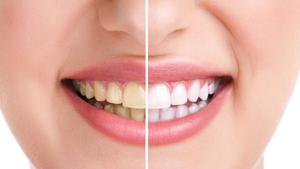 Don’t let yellow teeth ruin the perfect selfie for you!(Getty Images/iStockphoto) Don’t let yellow teeth ruin the perfect selfie for you!(Getty Images/iStockphoto)