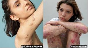 London-based photographer Sophie Mayenne’s project ‘Behind the Scars’ celebrates people’s scars and the stories behind them. (Sophie Mayenne/Instagram) London-based photographer Sophie Mayenne’s project ‘Behind the Scars’ celebrates people’s scars and the stories behind them. (Sophie Mayenne/Instagram)