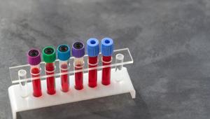 Hepatitis C virus (HCV) infection represents a major healthcare burden in India, with an estimated 12-18 million people infected.(Shutterstock) Hepatitis C virus (HCV) infection represents a major healthcare burden in India, with an estimated 12-18 million people infected.(Shutterstock)