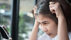 Hair loss and baldness can be managed with proper care and the right treatment.(Shutterstock) Hair loss and baldness can be managed with proper care and the right treatment.(Shutterstock)