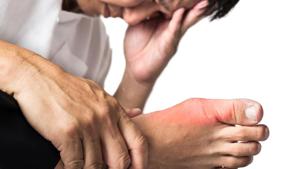 Gout is caused by the build-up of urate crystals in a joint.(Shutterstock) Gout is caused by the build-up of urate crystals in a joint.(Shutterstock)