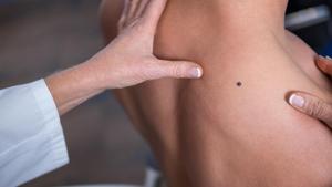 The performance of AI was compared with that of 58 international dermatologists and found that the AI missed fewer melanomas compared to them.(Shutterstock) The performance of AI was compared with that of 58 international dermatologists and found that the AI missed fewer melanomas compared to them.(Shutterstock)