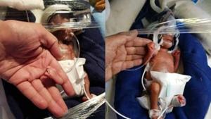 The mother went into labour in the 26th week of pregnancy.(HT Photo) The mother went into labour in the 26th week of pregnancy.(HT Photo)