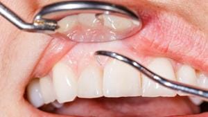 You need to go for regular dental checkups to make sure you don’t develop gum disease.(Shutterstock) You need to go for regular dental checkups to make sure you don’t develop gum disease.(Shutterstock)