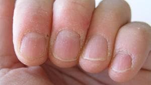 Skin peeling around nails due to dryness (Getty Images/iStockphoto) Skin peeling around nails due to dryness (Getty Images/iStockphoto)