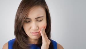 Until now, ulcers and lesions inside the mouth were treated using either creams or mouthwashes.(Shutterstock) Until now, ulcers and lesions inside the mouth were treated using either creams or mouthwashes.(Shutterstock)