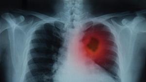 It turns out that this variant form of SCLC tumours are derived from a separate class of rare cells called tuft cells.(Shutterstock)