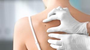 The goal of all clinical teams is to catch the skin cancer early and manage it with the newest targeted therapies.(Shutterstock) The goal of all clinical teams is to catch the skin cancer early and manage it with the newest targeted therapies.(Shutterstock)