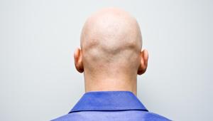 Now, thanks to hair transplant clinics, men are opting for hair transplants inspired by celebrities, and not really haircuts.(Getty Images) Now, thanks to hair transplant clinics, men are opting for hair transplants inspired by celebrities, and not really haircuts.(Getty Images)