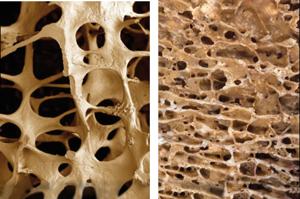Osteoporosis is dangerous as bones become fragile and can break easily Osteoporosis is dangerous as bones become fragile and can break easily