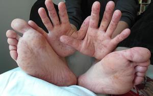 The infection causes a painful reddish blister in the mouth, hands, feet and thighs in children below 10 years of age(Representational photo) The infection causes a painful reddish blister in the mouth, hands, feet and thighs in children below 10 years of age(Representational photo)
