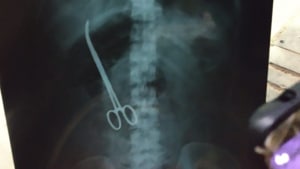 The woman underwent a surgery for hernia in November when doctors forgot to remove the pair of forceps from her abdomen.(Sourced) The woman underwent a surgery for hernia in November when doctors forgot to remove the pair of forceps from her abdomen.(Sourced)