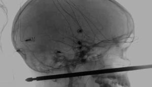 Two tapeworms found inside the brain of a toddler in Haryana’s Mahendragarh. (Representative Image)(AP) Two tapeworms found inside the brain of a toddler in Haryana’s Mahendragarh. (Representative Image)(AP)