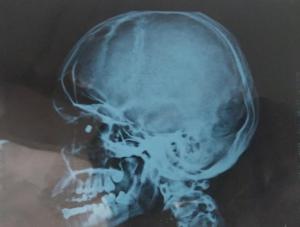 In the first round of surgery, doctors removed the pellet, repaired the sclera-white portion of the eye, and reattached the retina to the wall using silicone oil. In the first round of surgery, doctors removed the pellet, repaired the sclera-white portion of the eye, and reattached the retina to the wall using silicone oil.