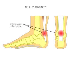 Runners who do a lot of hill running are particularly prone to Achilles tendon issues(Shutterstock) Runners who do a lot of hill running are particularly prone to Achilles tendon issues(Shutterstock)