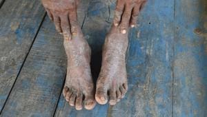 With the city’s maximum temperature averaging 41 degrees Celsius in the past 10 days, as per the India Meteorological Department, doctors in the city said they had seen a significant rise in the number of people coming in with skin illnesses.(AFP) With the city’s maximum temperature averaging 41 degrees Celsius in the past 10 days, as per the India Meteorological Department, doctors in the city said they had seen a significant rise in the number of people coming in with skin illnesses.(AFP)