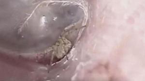 The spider was living inside Li’s ear for quite a while .(Twitter/@OddGistHQ) The spider was living inside Li’s ear for quite a while .(Twitter/@OddGistHQ)