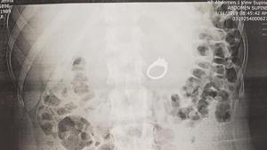 An X-ray sure enough confirmed that she had swallowed the ring.(Facebook/Jenna Evans) An X-ray sure enough confirmed that she had swallowed the ring.(Facebook/Jenna Evans)