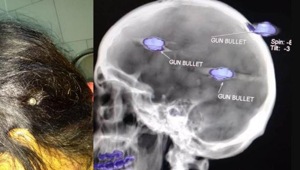 Sumeet Kaur survived with three bullets in the head and one in the jaw. Her nephew shot at her mother Sukhjinder Kaur and her in a fit of rage over a land dispute. Both women have been operated upon and are out of danger. (HT Photo) Sumeet Kaur survived with three bullets in the head and one in the jaw. Her nephew shot at her mother Sukhjinder Kaur and her in a fit of rage over a land dispute. Both women have been operated upon and are out of danger. (HT Photo)