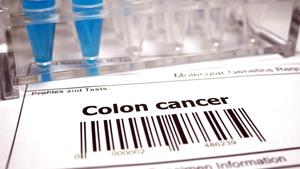 Colon cancer mostly occurs in those older than 50 years of age.(iStock) Colon cancer mostly occurs in those older than 50 years of age.(iStock)