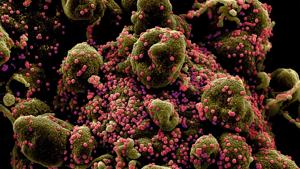 Colorized scanning electron micrograph of an apoptotic cell (greenish brown) heavily infected with SARS-COV-2 virus particles (pink), also known as novel coronavirus, isolated from a patient sample.(via REUTERS) Colorized scanning electron micrograph of an apoptotic cell (greenish brown) heavily infected with SARS-COV-2 virus particles (pink), also known as novel coronavirus, isolated from a patient sample.(via REUTERS)