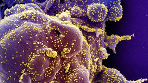 Colorized scanning electron micrograph of an apoptotic cell (purple) infected with SARS-COV-2 virus particles.(REUTERS) Colorized scanning electron micrograph of an apoptotic cell (purple) infected with SARS-COV-2 virus particles.(REUTERS)