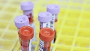 A genetic analysis of Covid-19 patients suggests that blood type might influence whether someone develops severe disease. (Representational Image)(Unsplash) A genetic analysis of Covid-19 patients suggests that blood type might influence whether someone develops severe disease. (Representational Image)(Unsplash)