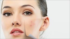 5 overnight quick-fix home remedies to cure pimples(Twitter/EscuelaOmnilife) 5 overnight quick-fix home remedies to cure pimples(Twitter/EscuelaOmnilife)