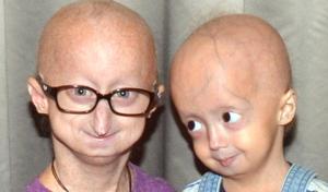 Representational Image(ProgeriaResearch.org)