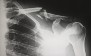 A new study published in the Journal of Bone and Mineral Research suggests that exercise can help in protecting bone health after surgery.(Unsplash) A new study published in the Journal of Bone and Mineral Research suggests that exercise can help in protecting bone health after surgery.(Unsplash)