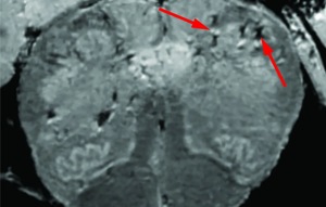 In an in-depth study of how Covid-19 affects a patient’s brain, National Institutes of Health researchers consistently spotted hallmarks of damage caused by thinning and leaky brain blood vessels in tissue samples from patients who died shortly after contracting the disease.(Yahoo) In an in-depth study of how Covid-19 affects a patient’s brain, National Institutes of Health researchers consistently spotted hallmarks of damage caused by thinning and leaky brain blood vessels in tissue samples from patients who died shortly after contracting the disease.(Yahoo)